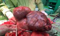 Removing the 11 kg tumor from the patients abdomen in Gerash Hospital